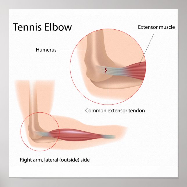 Tennis coude Sport blessure Poster (Devant)