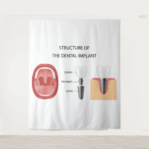 Tenture Structure de l'implant dentaire