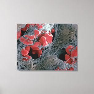 Toile Caillot sanguin 2