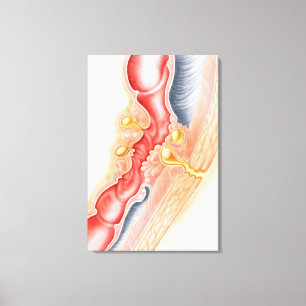 Toile Développement De La Fistule