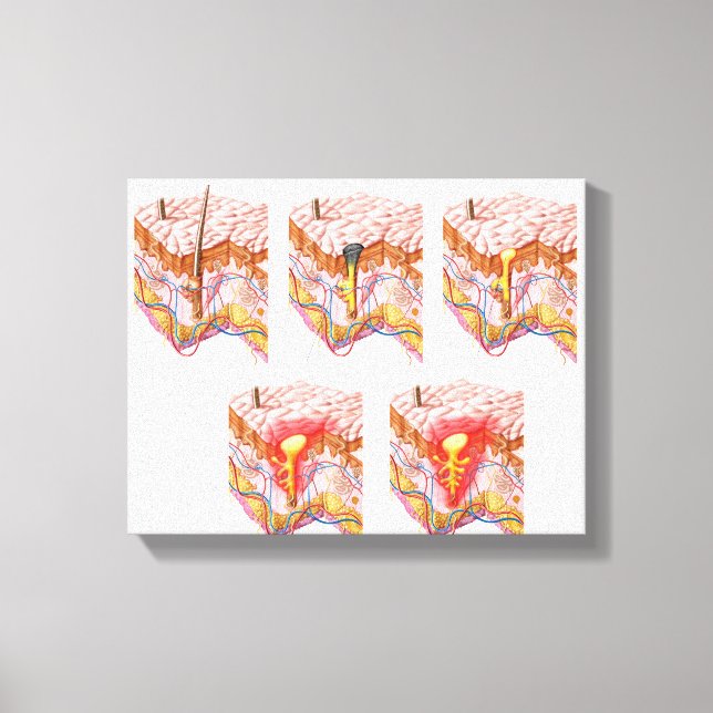 Toile Différents Types D'Acné (Recto)