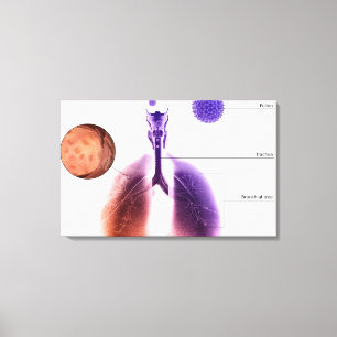 Toile Illustration d'une crise d'asthme de pollen