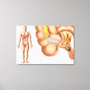 Toile Illustration Médicale D'Un Appendice