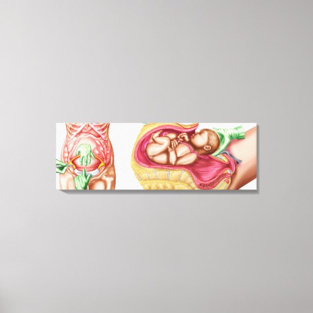 Toile Illustration Montrant La Livraison Cesarienne Du F (Recto)