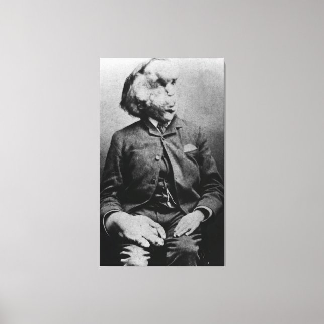 Toile Joseph "John" Merrick L'homme éléphant de 1889 (Recto)