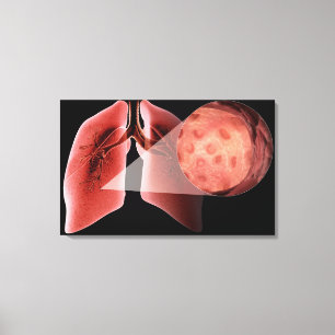 Toile Voie aérienne d'Inflammed pendant une crise