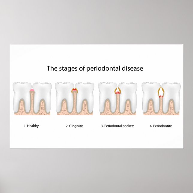 Tooth Periodontal Disease Poster (Vorne)