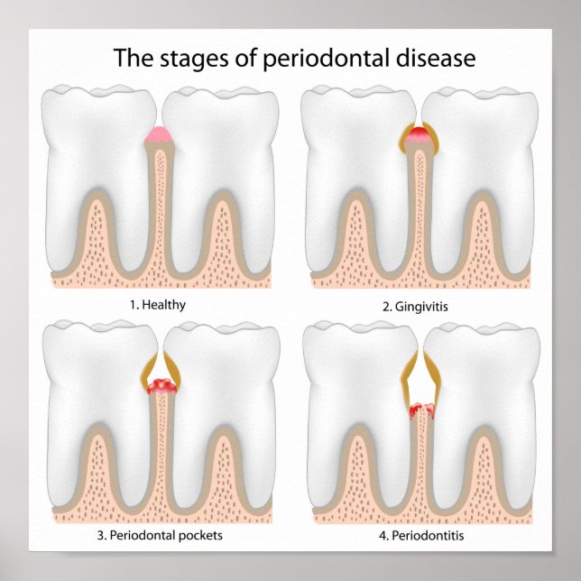 Tooth Periodontal Disease Poster (Vorne)