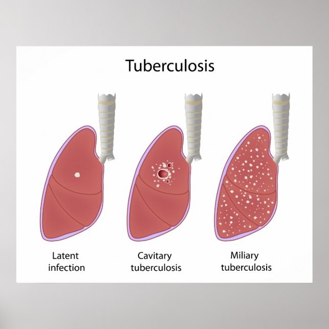 Types de tuberculose Poster (Devant)