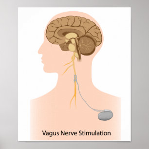 Vagus Nervenstimulation Poster