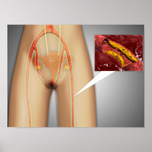 Verengte Arterie nahe Bein-Nahaufnahme Poster