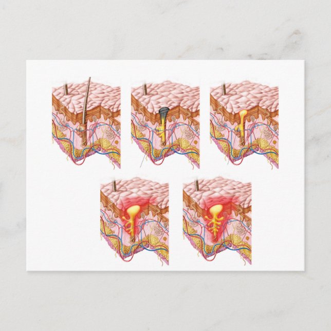 Verschiedene Arten von Akne Postkarte (Vorderseite)