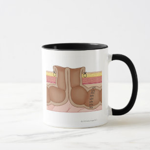 Vorübergehender Colostomy Tasse