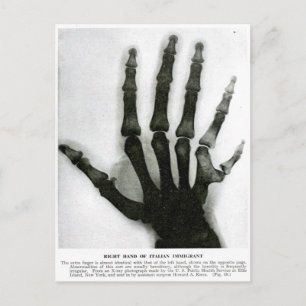 X-Ray Hand mit Extra Finger Postkarte