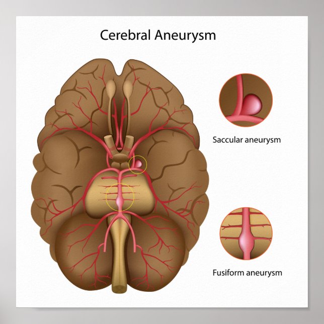 Zerebrale Aneurysma Poster (Vorne)