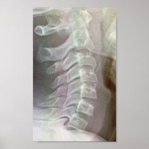 Zervikale Dorn Krawatte Poster